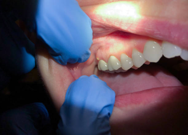 Best Emergency Dental Care for Broken or Chipped Teeth in Stansberry Lake, WA